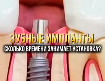 Доступные зубные импланты: это возможно! 