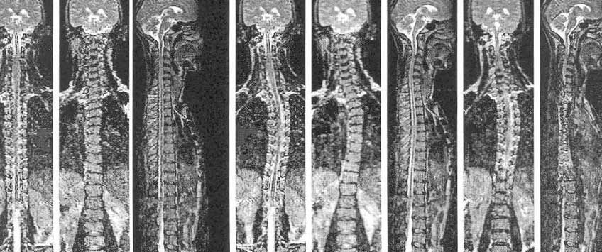 МРТ позвоночника
