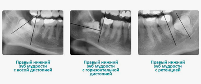 Удаление зуба мудрости